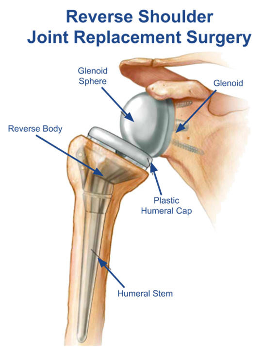Reverse Total Shoulder Replacement Bunbury Foot & Ankle Surgeon