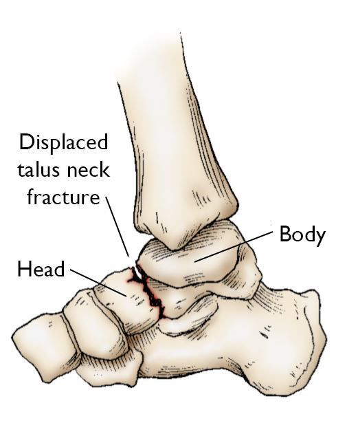 talus bone fracture recovery time