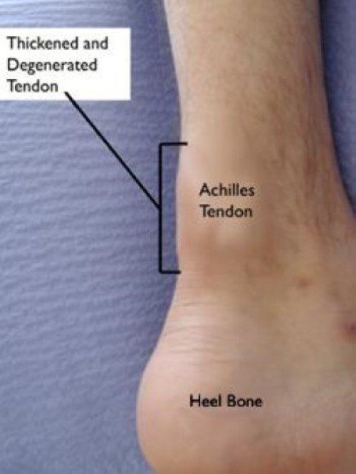 Heel Spur Stiff Sore Achilles Tendon Morning Tendinitis Achilles