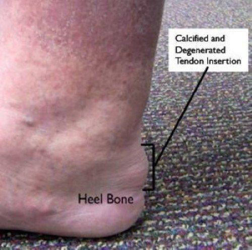 Plantar Fasciitis: The Achilles Heel of Foot and Ankle Surgeons
