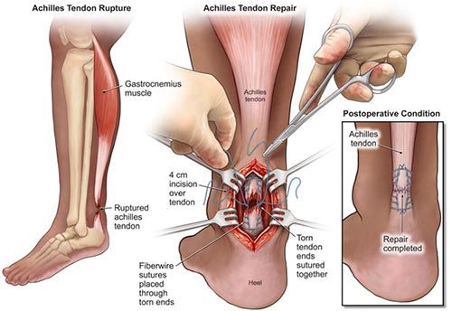 Achilles Tendon Repair Surgery Post-operative Instructions Phase