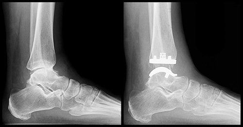 Ankle Fractures - Bunbury Foot & Ankle Surgeon