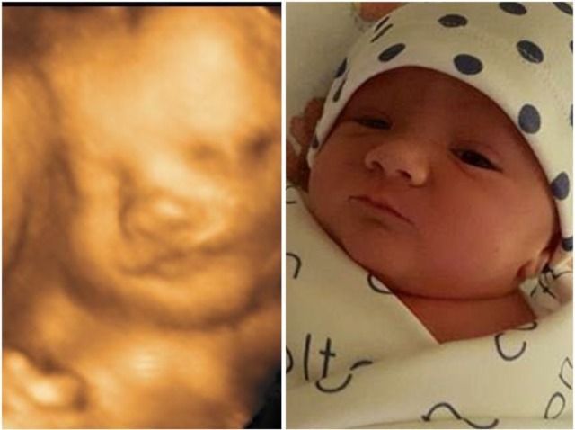 Ultrasound scan of a baby's face next to a photo of the newborn with a grumpy expression, wearing a polka dot hat.