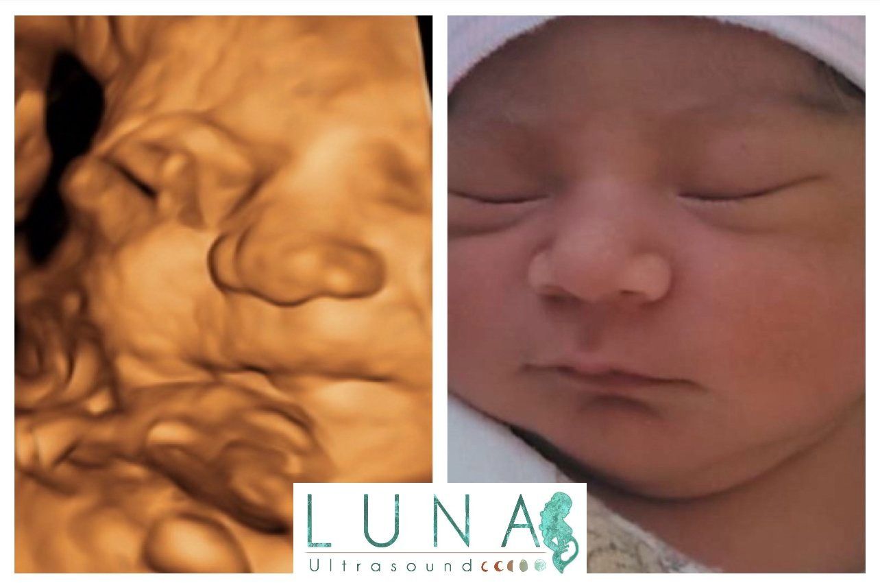 Comparison of a 3D ultrasound image and a newborn baby's face. The ultrasound shows a brown-toned profile, while the baby has closed eyes and a dark complexion.