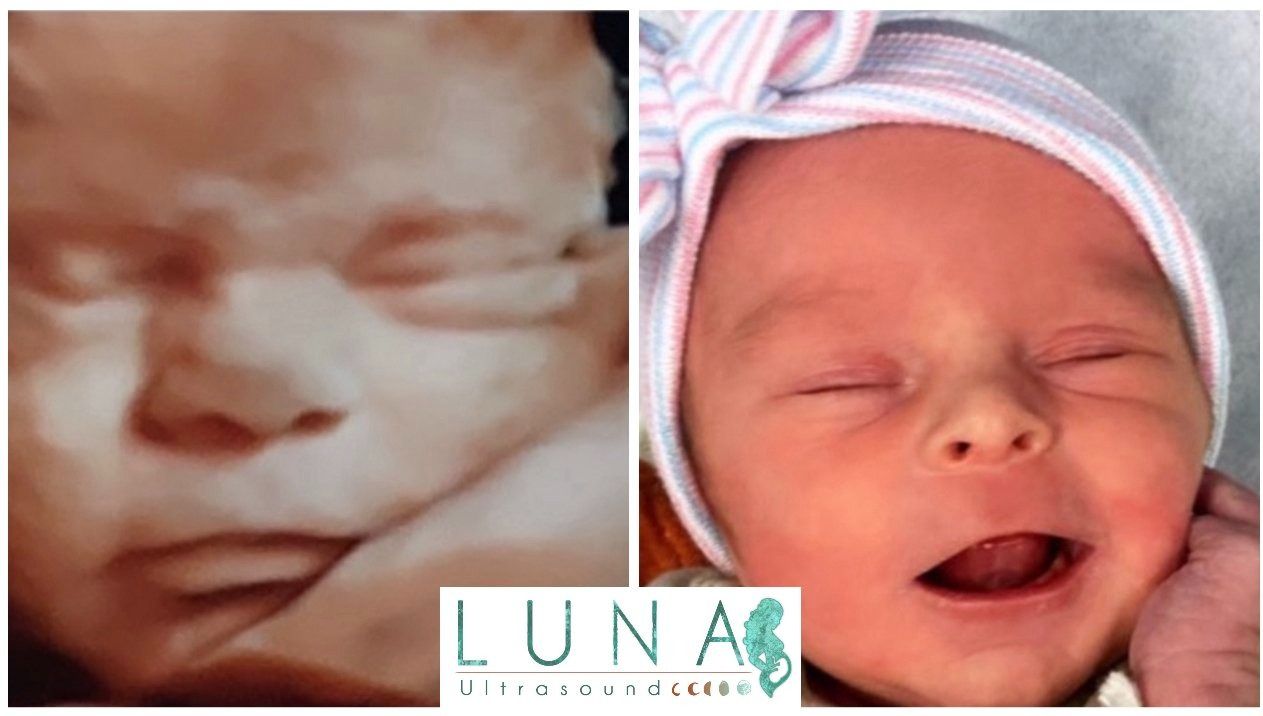 Comparison of a fetal ultrasound with a newborn. The ultrasound shows a baby’s face; the newborn has its eyes closed and mouth open.