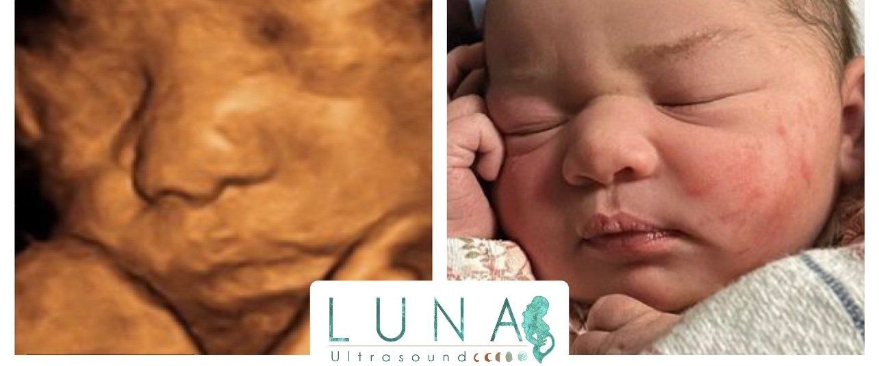 Comparison of a 3D ultrasound and newborn baby. The ultrasound shows the baby's nose and face. The baby's face is shown after birth.
