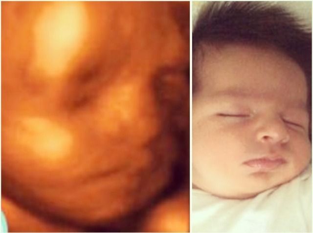 Side-by-side comparison: a 3D ultrasound of a baby's face and the baby sleeping with closed eyes.