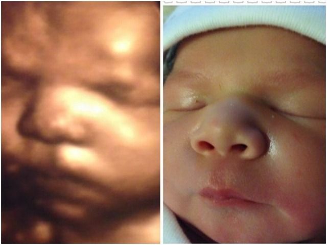 Comparison of a baby's 3D ultrasound scan to a newborn's face. The newborn's face is smooth, with closed eyes and a slightly parted mouth.