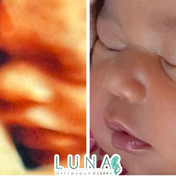 Comparison of a baby's ultrasound with a photo. The ultrasound shows lips and a nose. The photo shows the baby's face, lips, and nose.