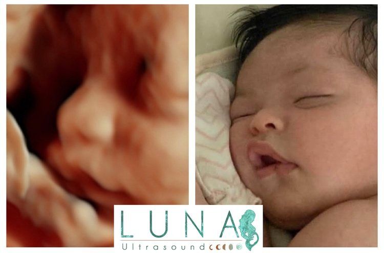 Comparison of a 3D ultrasound scan of a baby's face next to a photo of the baby after birth, sleeping.