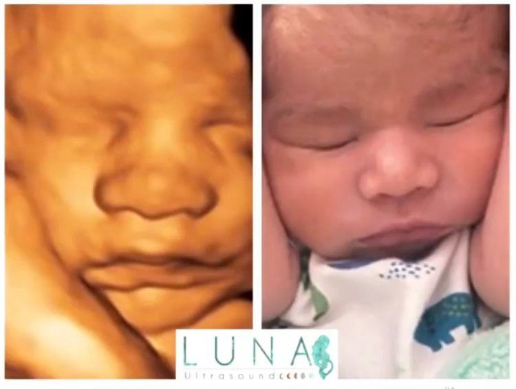 Comparison of a 3D ultrasound scan and a newborn baby's face; both show a sleeping baby.