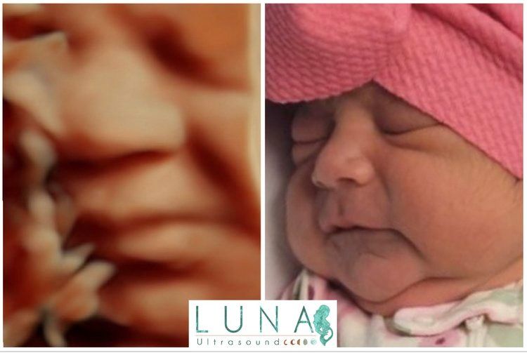 Side-by-side comparison: 3D ultrasound image of a baby's face next to a newborn baby wearing a pink bow, both with similar expressions.