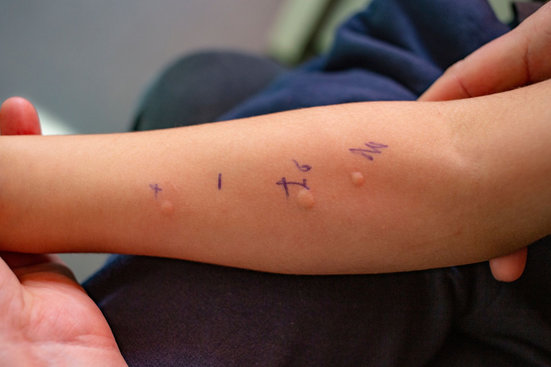 Skin prick allergy test on a little child's arm.