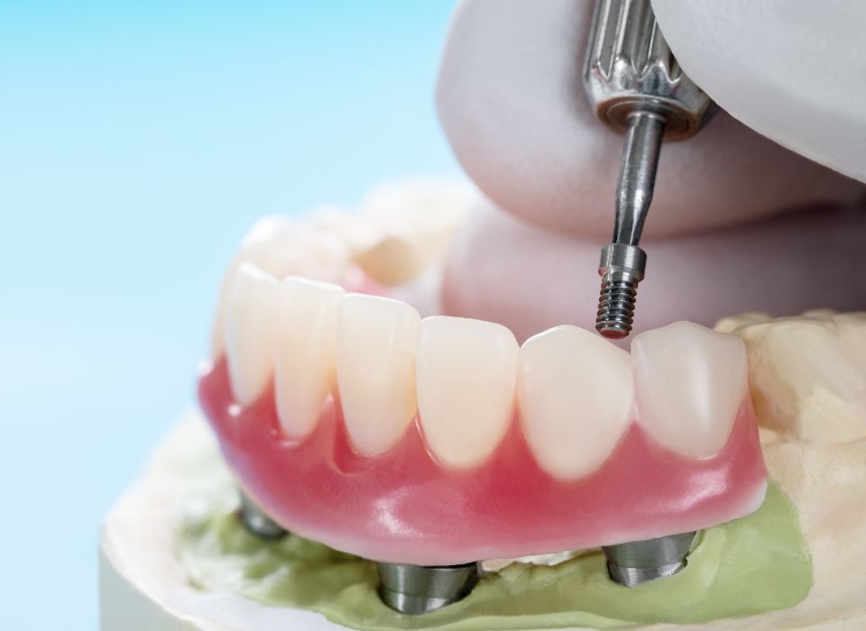 A dentist using a tool to attach a tooth implant to a dental mold of a new set of teeth.