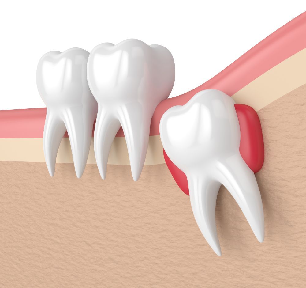 Illustration of impacted wisdom tooth, red inflamed gum, and other healthy teeth.