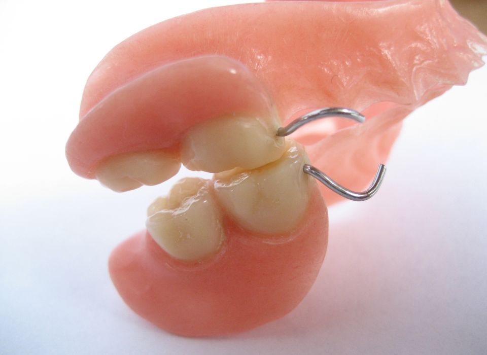 Partial denture with two artificial teeth, pink base, and metal clasps.