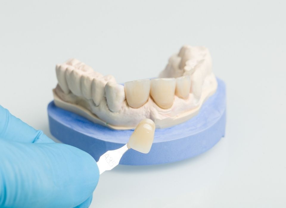 A gloved hand holds a tooth shade guide next to a dental model with crowns, on a blue base.