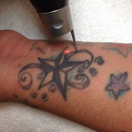 Dr. Jeffries - Redlands | 2023 Top Best Laser Tattoo Removal Inland Empire | Easy Quick Simple