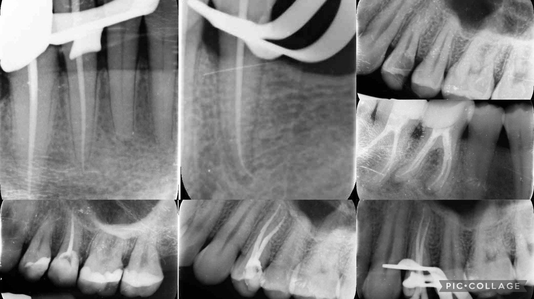endodonzia