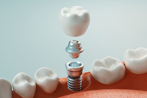 digital rendering of a dental implant