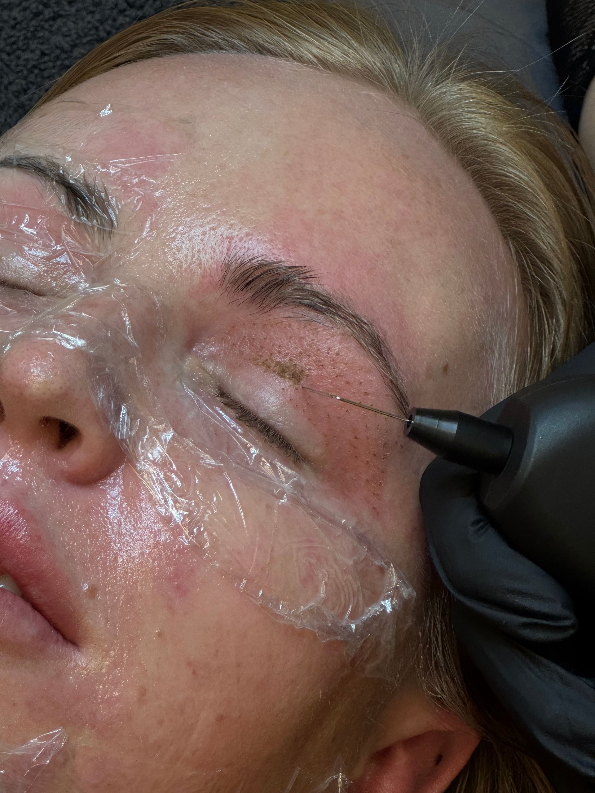 A man is getting a laser treatment on his eye.