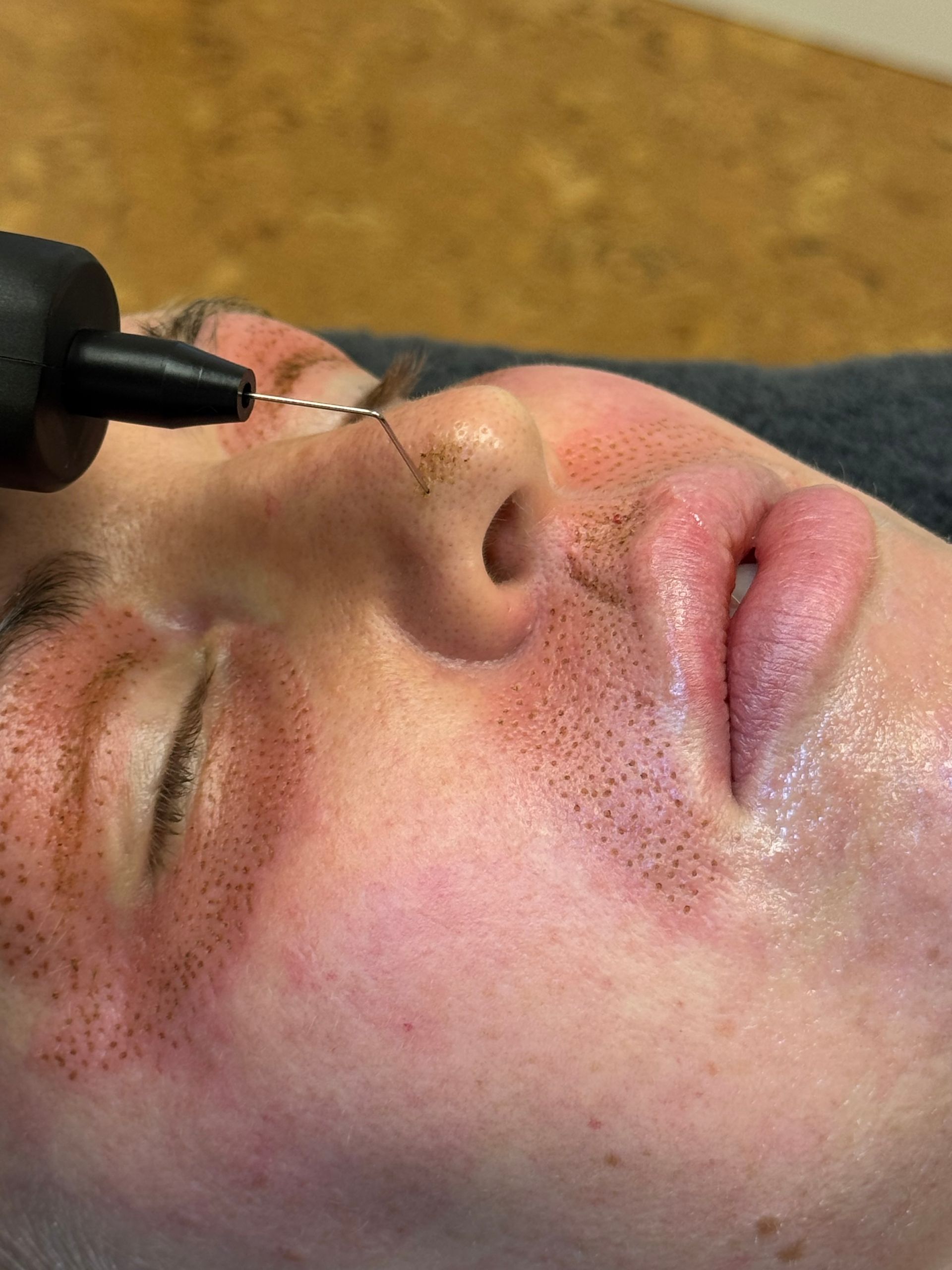 A person undergoing a plasma pen skin tightening treatment on their nose and under-eye area.