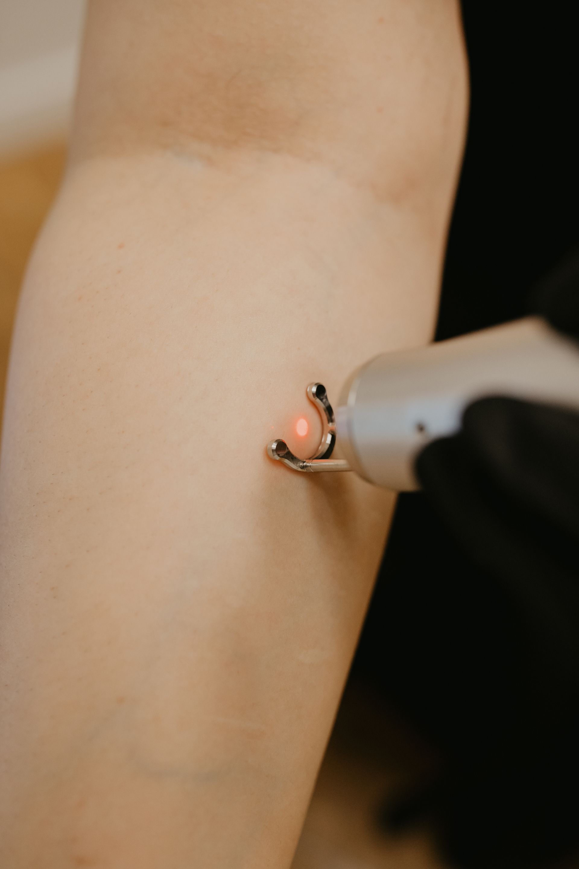 A hand in a black glove holding a silver laser device against a light-skinned arm.