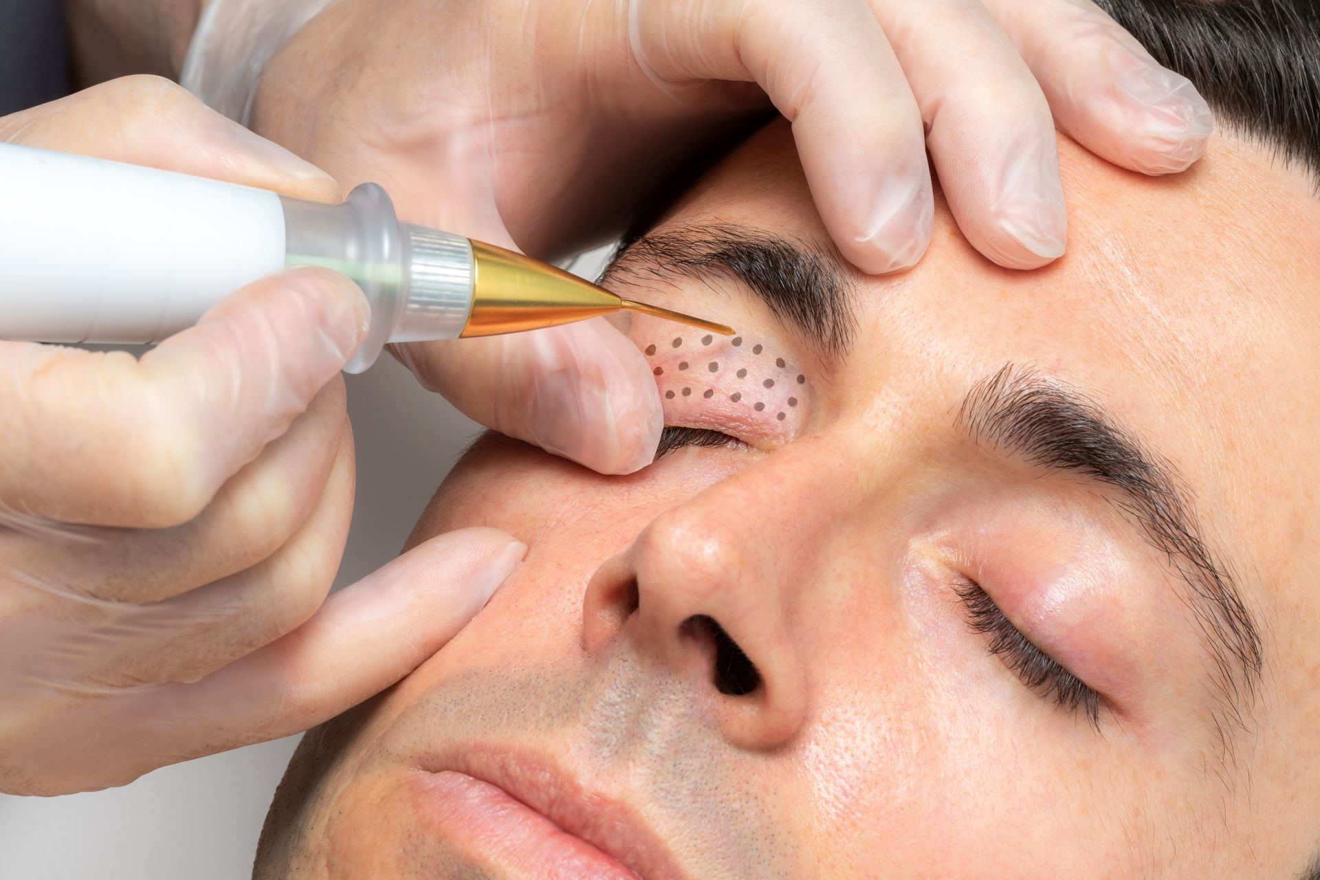 A man is getting a laser treatment on his eye.