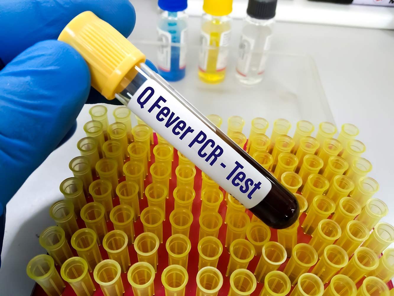 A Person is Holding a Test Tube That Says Q Fever PCR Test — Mount Archer Medical Centre in Berserker, QLD