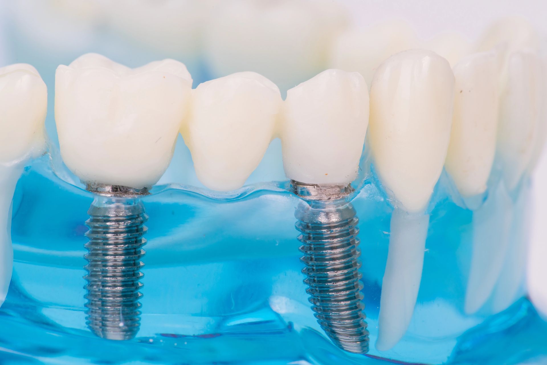 Modello di impianto dentale con due impianti metallici a supporto di denti bianchi in tessuto gengivale blu