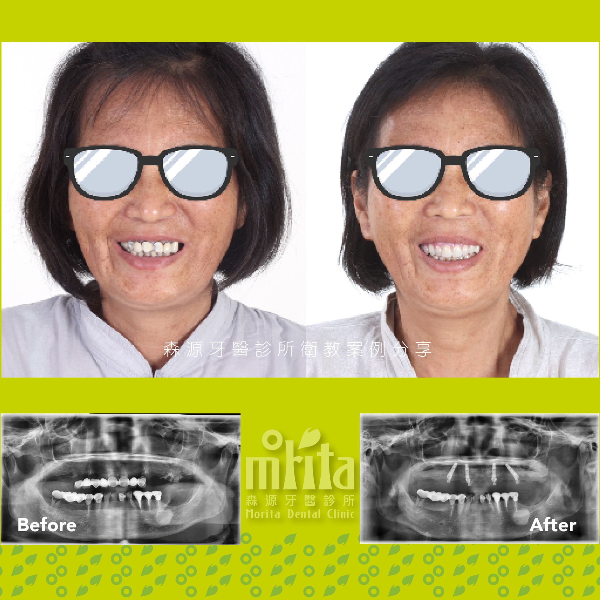 A before and after photo of a woman wearing sunglasses