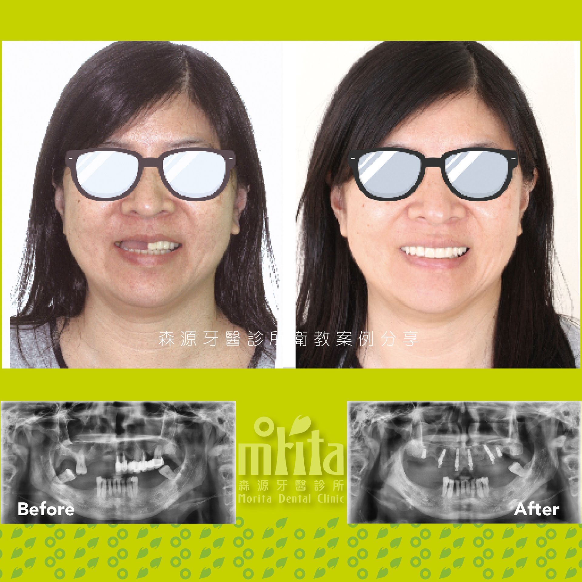 A before and after photo of a woman wearing sunglasses