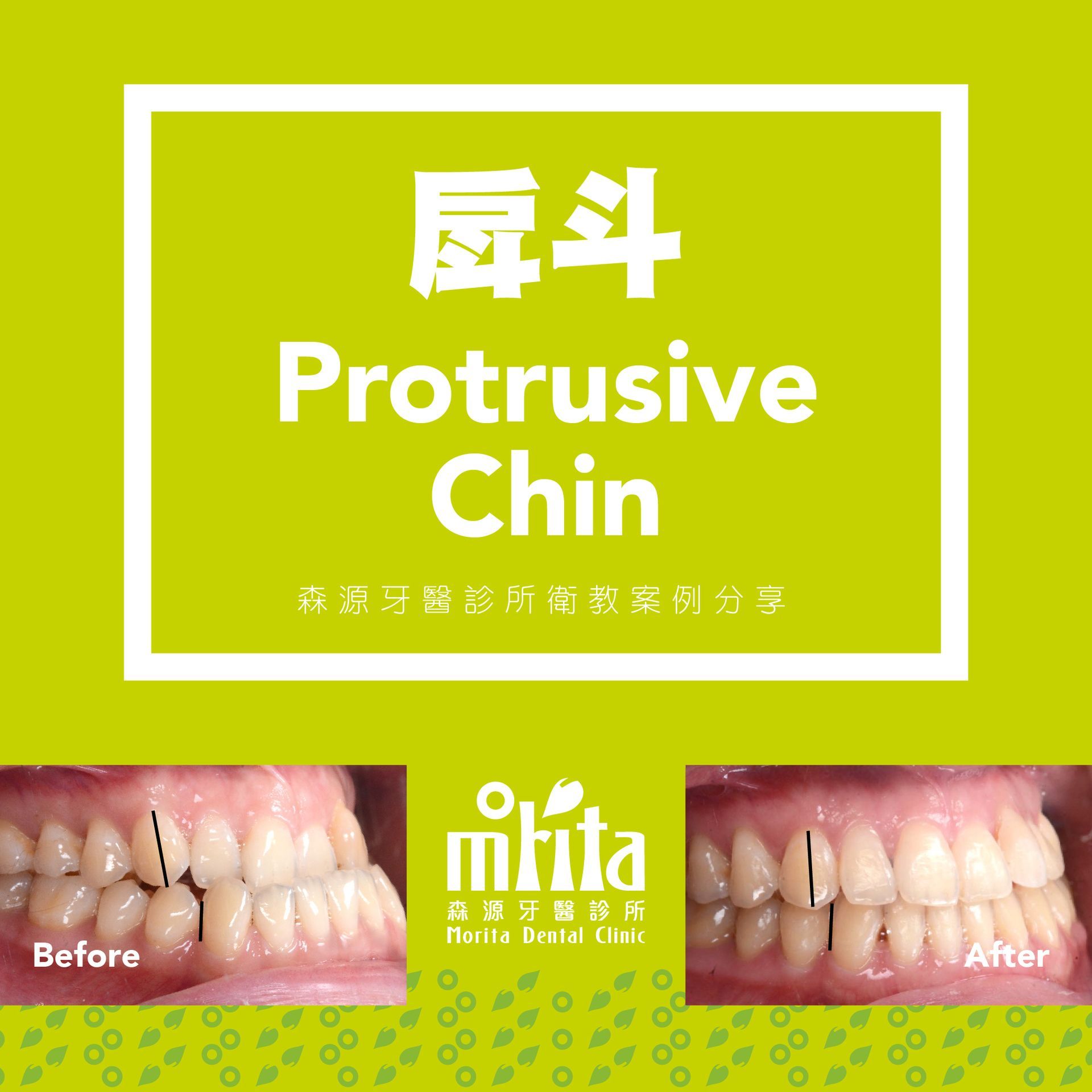 A before and after picture of a protrusive chin