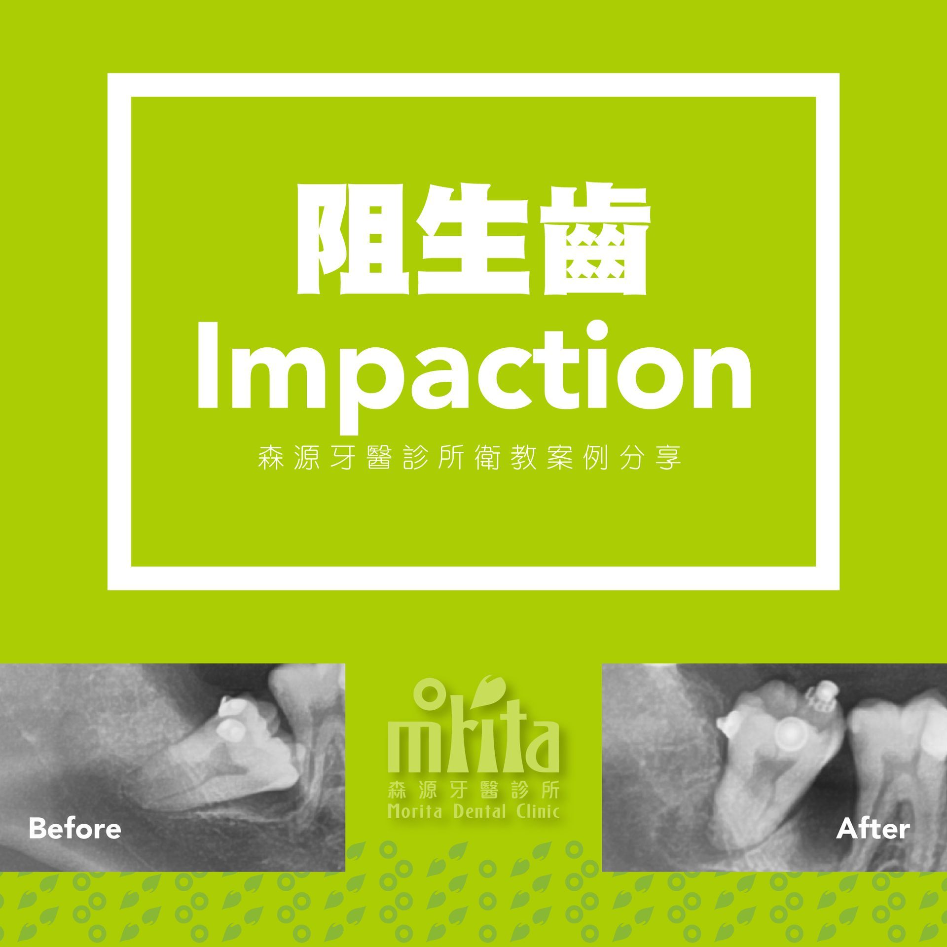 A before and after picture of a tooth impaction