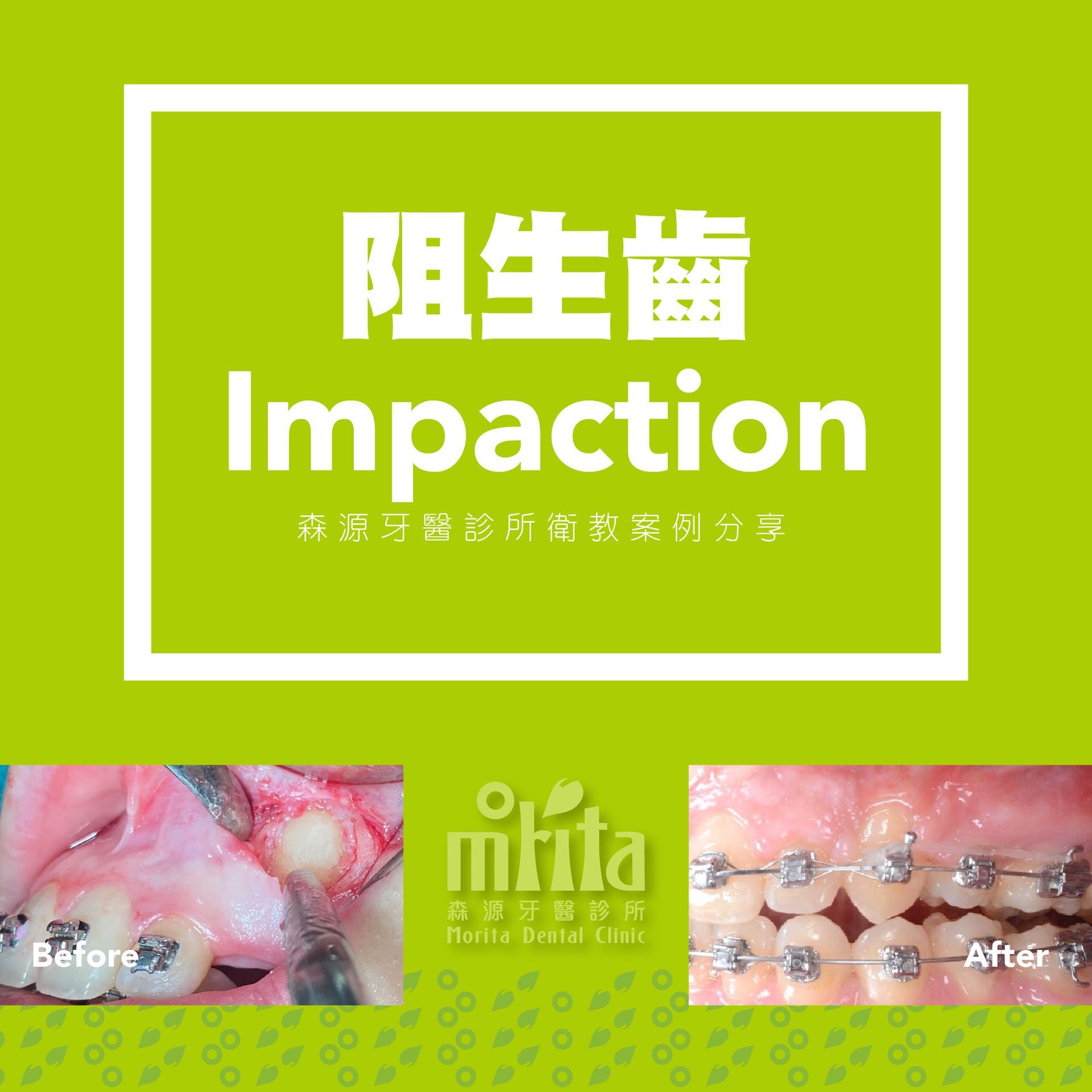 A before and after picture of a person 's teeth with braces