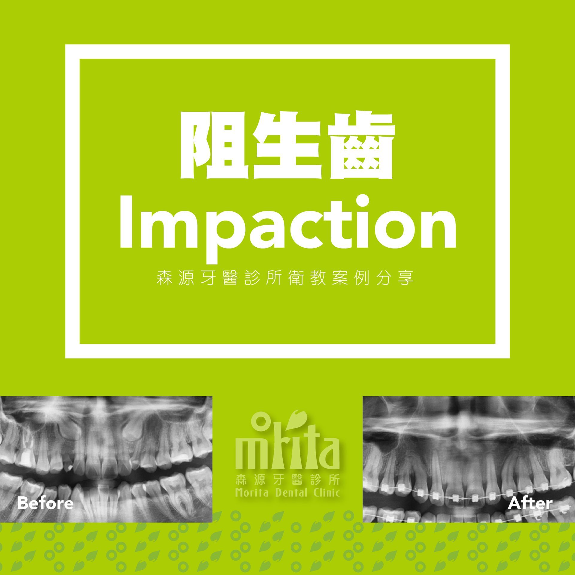 A before and after picture of a person 's teeth on a green background.