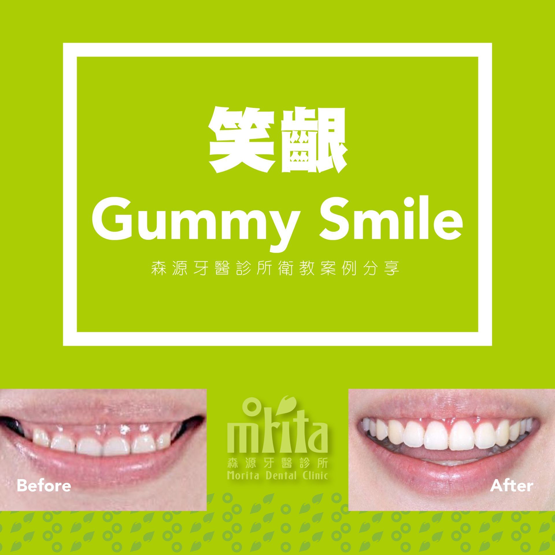 A before and after picture of a gummy smile