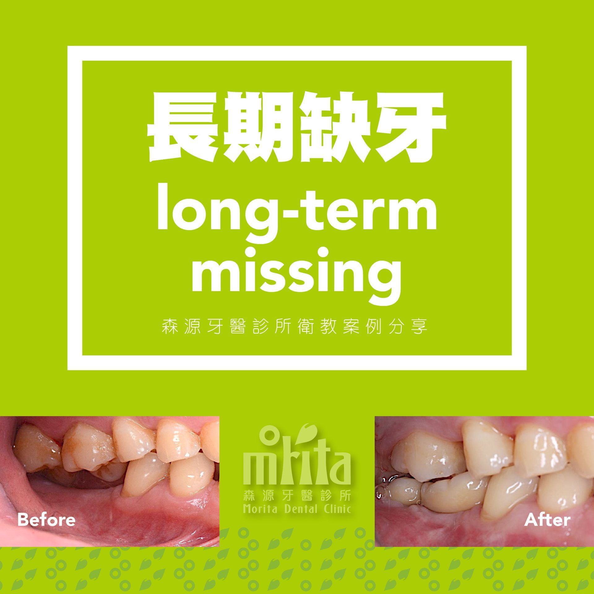A before and after picture of a long term missing tooth