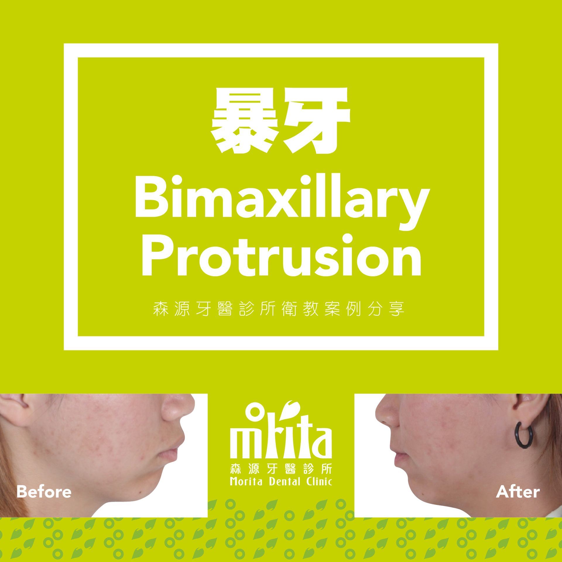 A before and after picture of a person with bimaxillary protrusion.