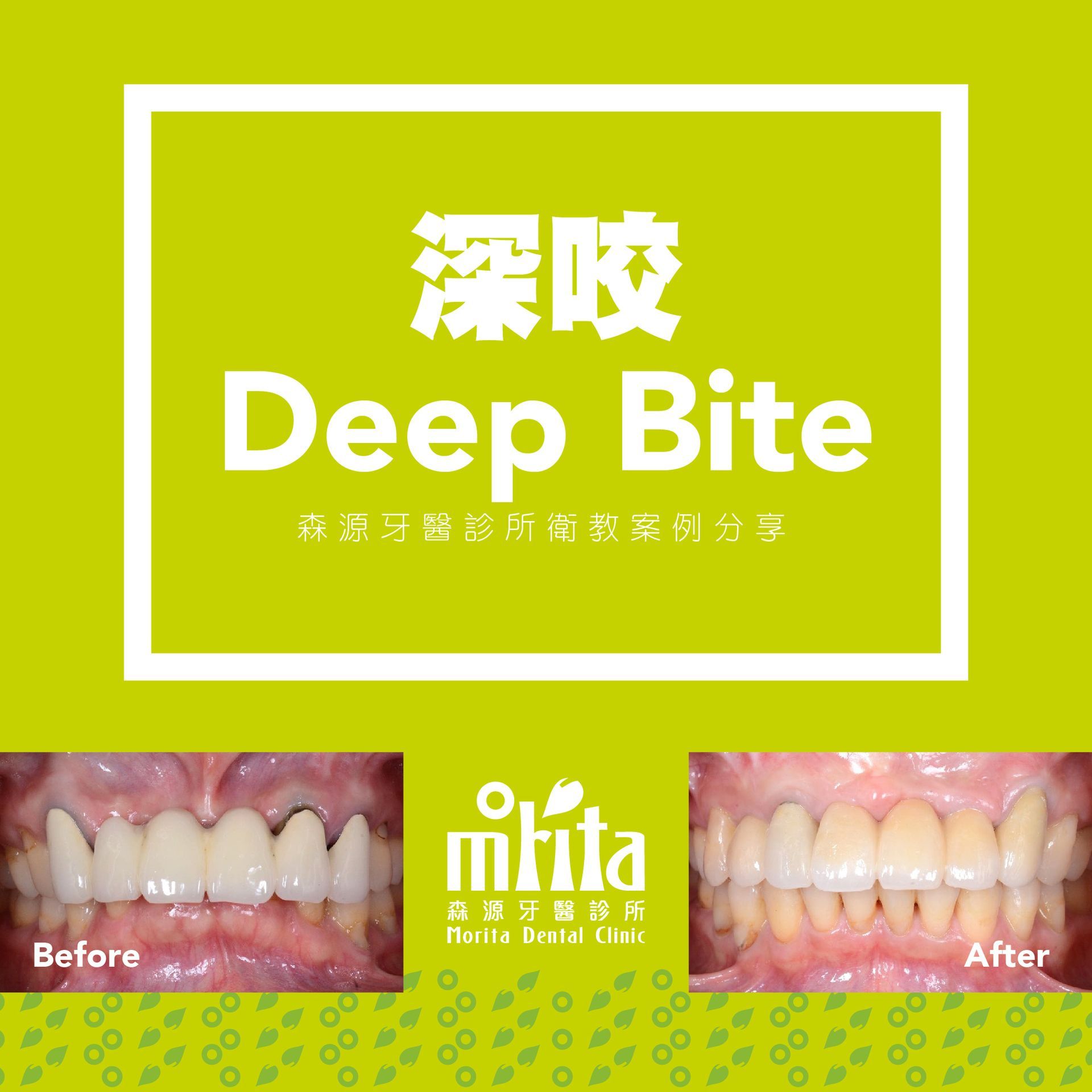 A picture of a person 's teeth before and after a deep bite