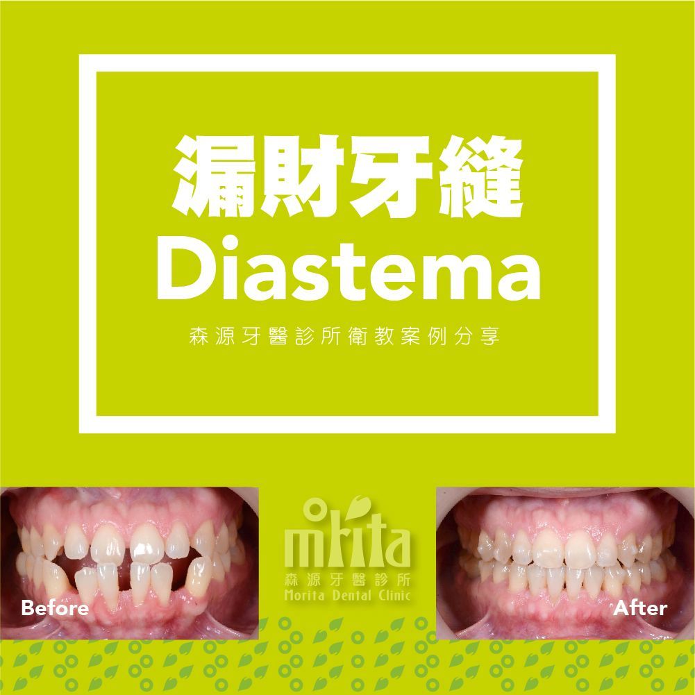 A before and after picture of a person 's teeth