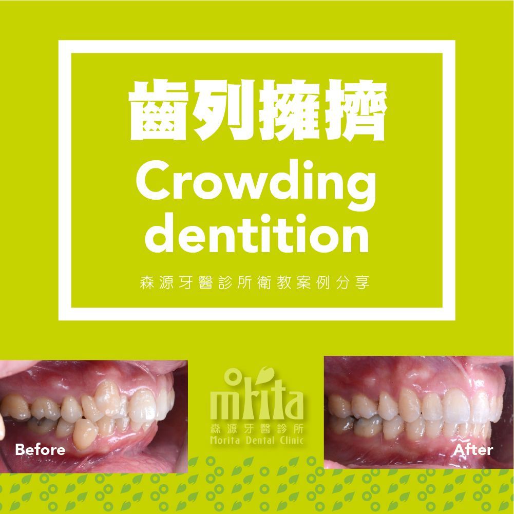 A before and after picture of crowding dentition