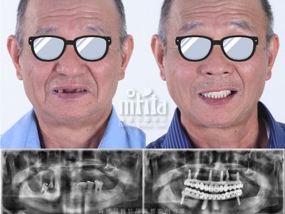 A before and after photo of a man with glasses