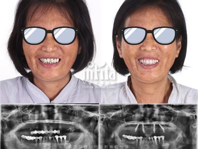 A before and after picture of a woman wearing sunglasses