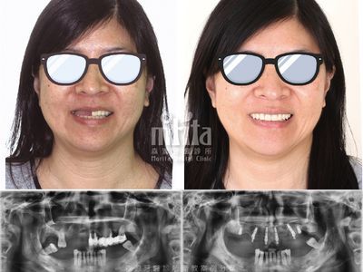 A before and after picture of a woman wearing glasses and smiling.