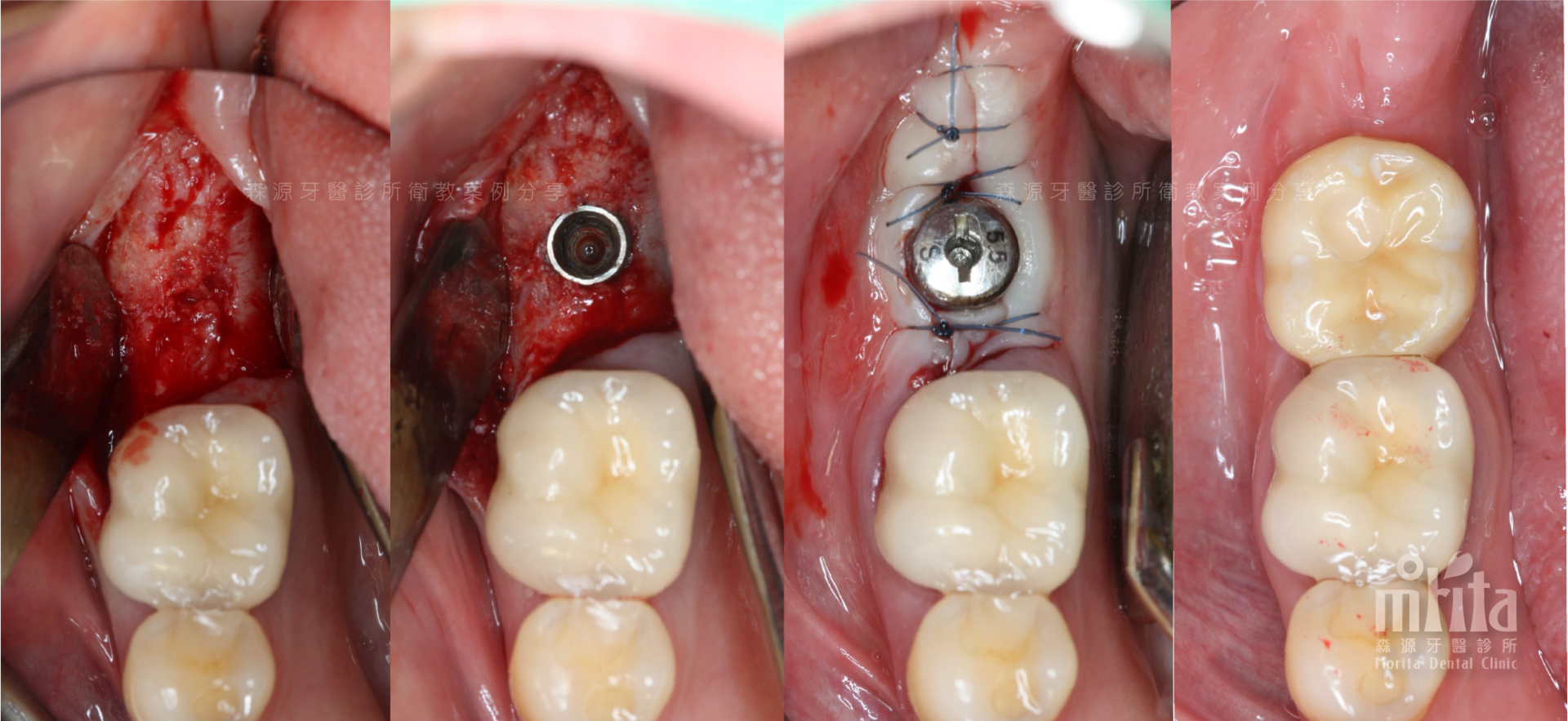 A close up of a person 's teeth with a hole in them.