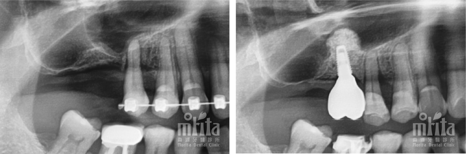 A black and white x-ray of a person 's teeth with braces.