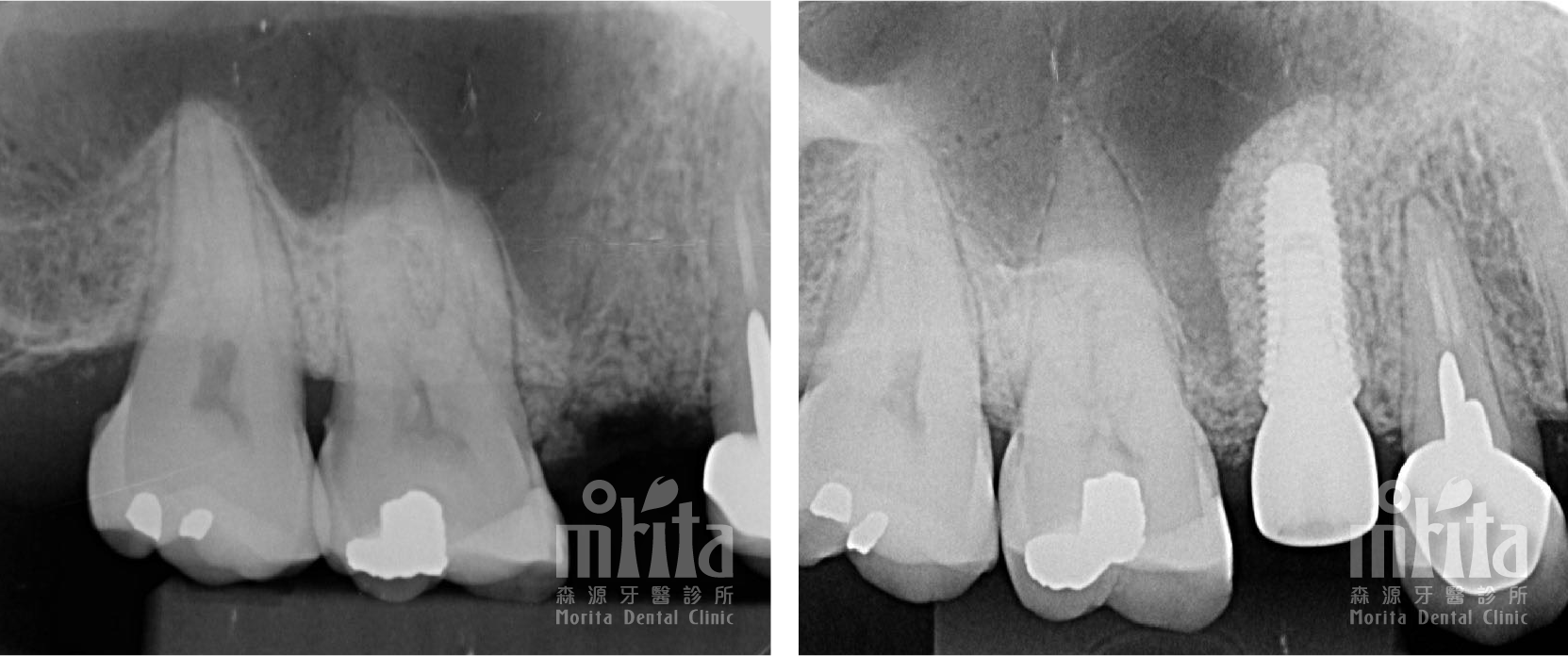 A black and white x-ray of a person 's teeth before and after dental treatment.