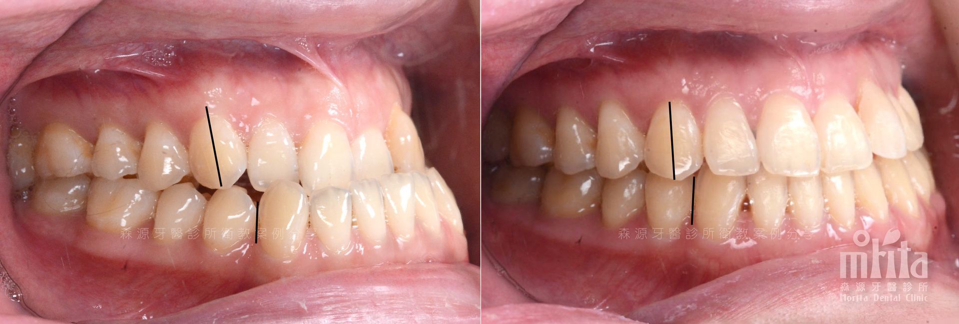 A before and after picture of a person 's teeth.