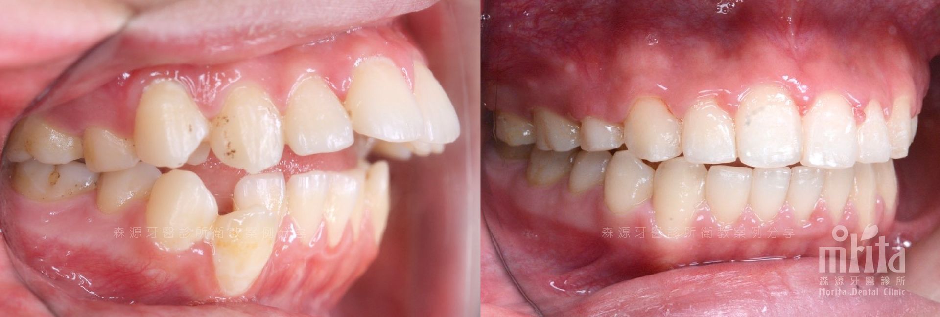 A close up of a person 's teeth before and after whitening.